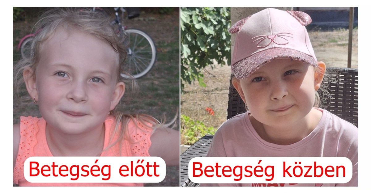 Együtt a ritka agydaganat ellen: Összefogás szükséges Hanna gyógykezeléséhez!