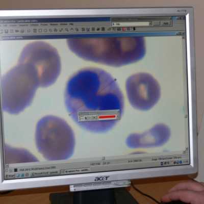 Mikroszkóp feltét átadása a Szt. István és Szt. László Kórházba - adó, 1%, alapítvány, támogatás