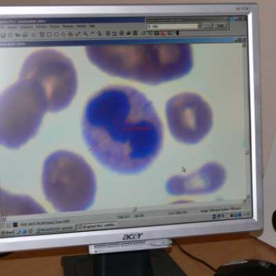 Mikroszkóp feltét átadása a Szt. István és Szt. László Kórházba - adó, 1%, alapítvány, támogatás