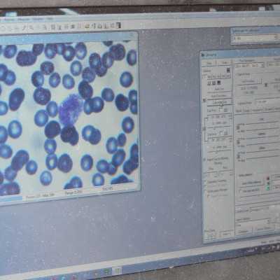 Nagy értékű műszerek átadása 1.877.576.- forint, értékben a DE OEC Gyermekklinika Hematológiájára - alapítvány, adó 1%, támogatás